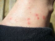 2011-04-10-049-Gorse-Spine-Injuries